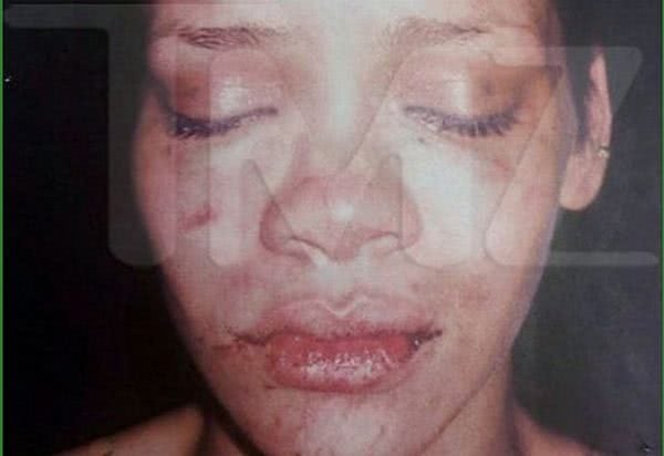 Rihanna injury
